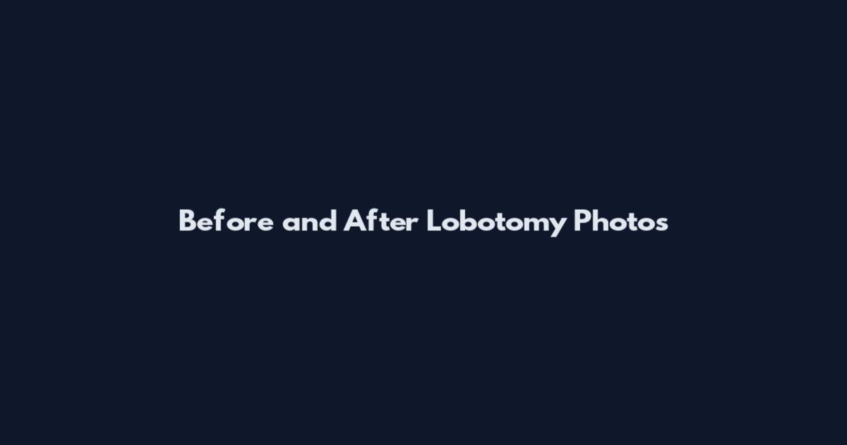 Before and After Lobotomy Photos