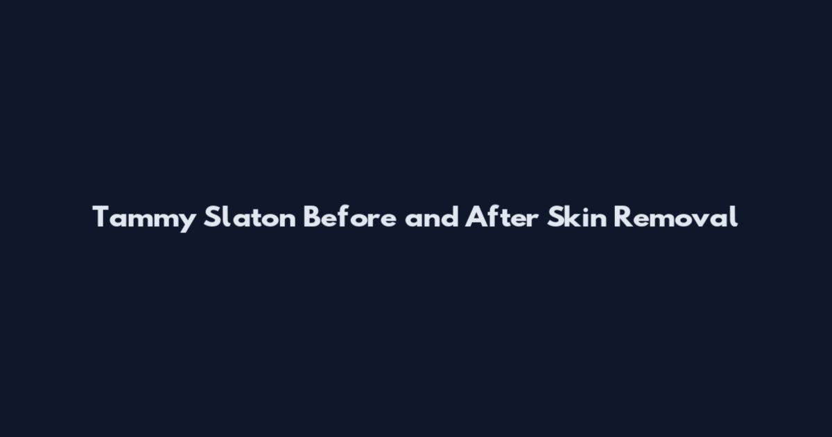 Tammy Slaton Before and After Skin Removal